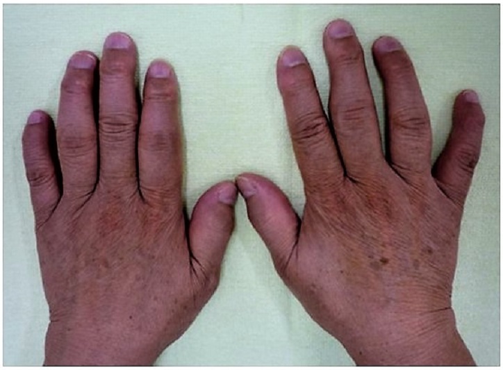 て 指 が の 血管 痛い 腫れ 手のひらの内出血に痛みが？その原因と対処法を解説！