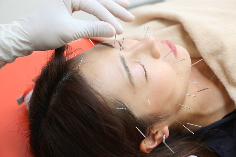 悩みに合わせて最適な箇所へ。首周りには微弱電流鍼を用いることで筋肉のこりを取り、血流を促進します